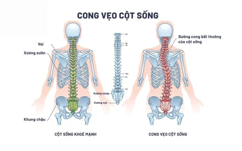 Ảnh Hưởng Đến Cột Sống